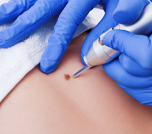 Lézeres pigmentfolt eltávolítás árak