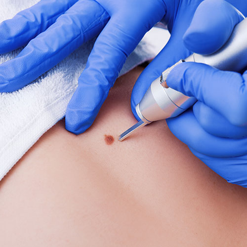 Lézeres pigmentfolt eltávolítás árak