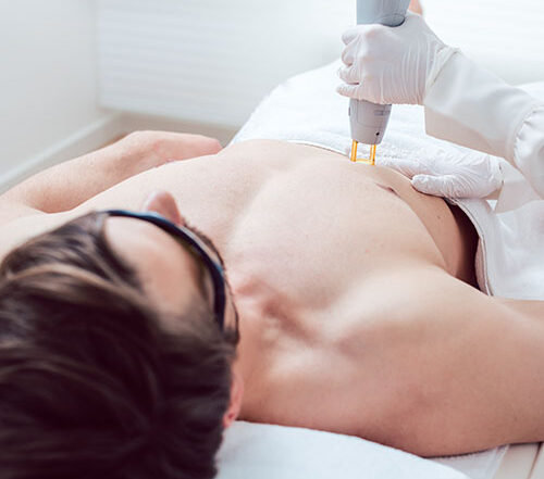 vegleges-szortelenites-ferfiaknak